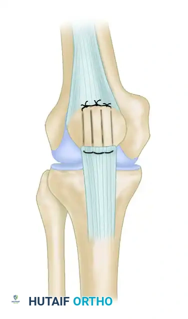 REPAIR WITH SUTURE THROUGH PATELLAR DRILL HOLES Surgical Diagram