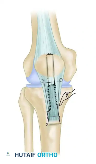 REPAIR WITH SUTURE THROUGH PATELLAR DRILL HOLES Surgical Diagram