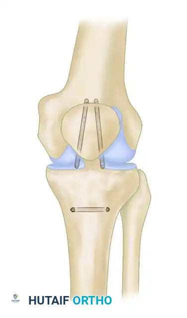 REPAIR WITH SUTURE THROUGH PATELLAR DRILL HOLES Surgical Diagram