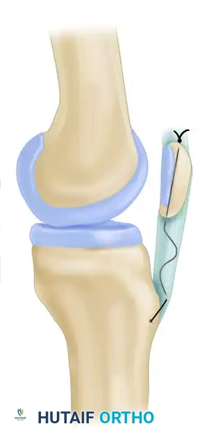 REPAIR WITH SUTURE THROUGH PATELLAR DRILL HOLES Surgical Diagram
