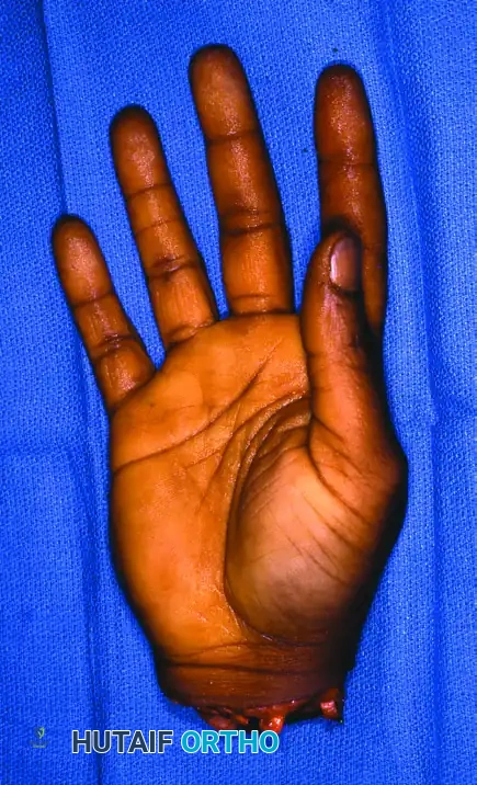 Upper Extremity Replantation: Surgical Principles and Microvascular Techniques