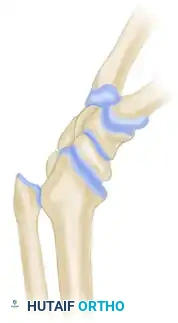 Resection of Dyschondrosteosis Lesion: Vickers Technique
