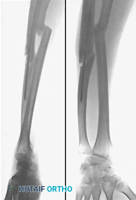 Complex Forearm Reconstruction: Radial Shaft Resection and Malunion Osteotomy