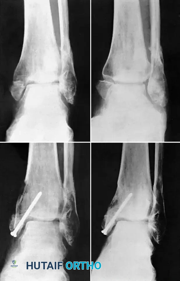 Management of Medial Malleolus and Tibial Shaft Nonunions