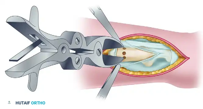 RESECTION OF THE DISTAL ULNA Surgical Diagram