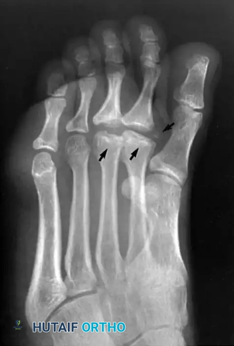 FIGURE 83-52 Freiberg infraction. Note flattening of second and third metatarsal heads and irregularity and separated bone fragment (arrows). (Courtesy of Steve Ikard, MD.)