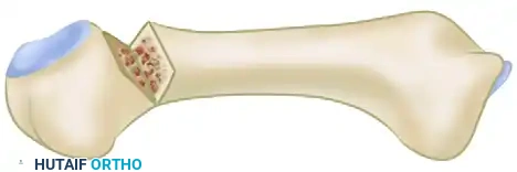 FIGURE 83-53 Dorsal closing wedge osteotomy and crosspinning. SEE TECHNIQUE 83-23.