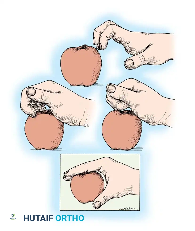 Fig. 68-17 Intrinsic muscle palsy. Flexion of metacarpophalangeal joints occurs only after interphalangeal joints are fully ﬂ exed.