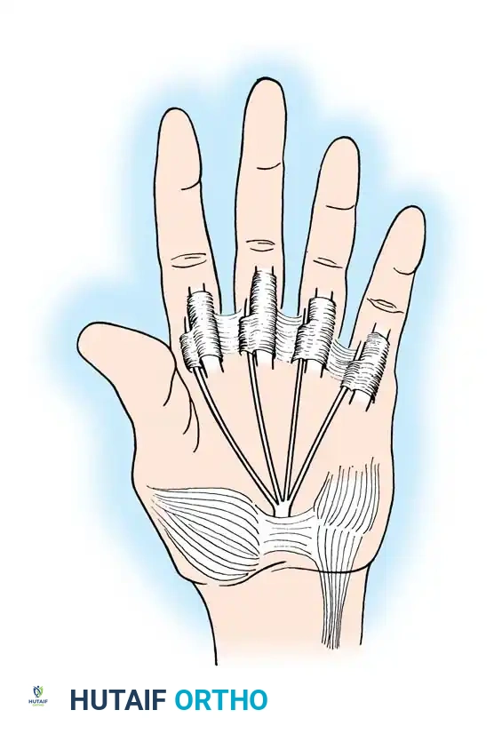 Fig. 68-18 Modiﬁ cation of Bunnell transfer to restore intrinsic function of ﬁ ngers