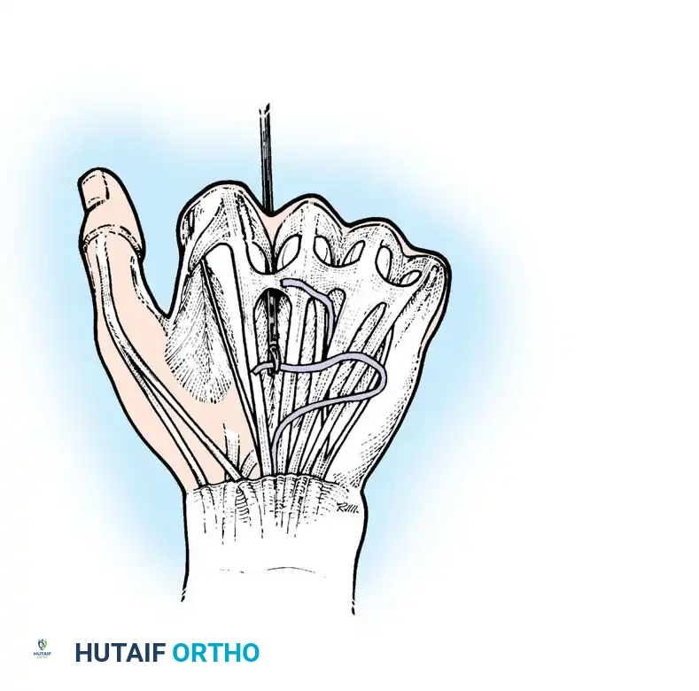 Site of extensor indicis proprius tendon