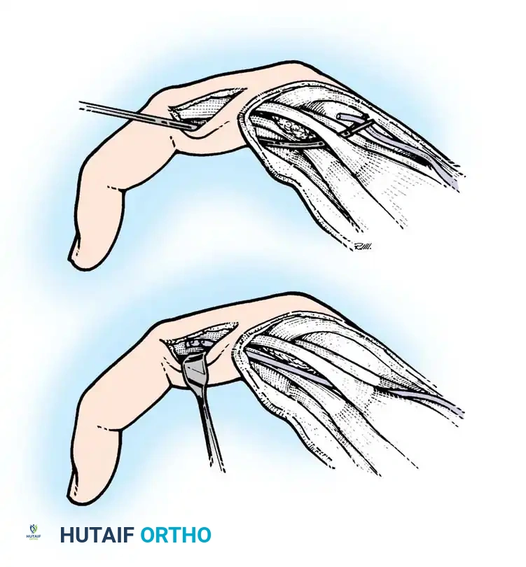 Clamp threading graft through interosseous space volar to transverse metacarpal ligament