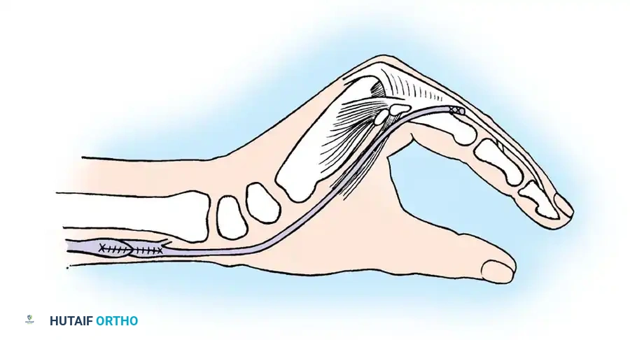 Fig. 68-24 Brand transfer of extensor carpi radialis longus or brevis, ﬁ rst to volar side of forearm