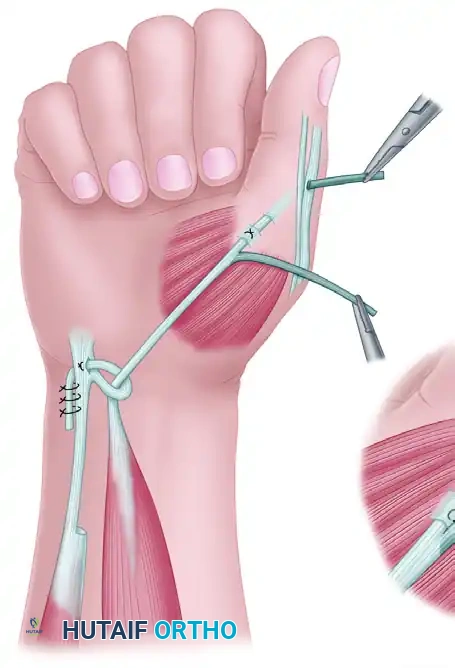 RESTORATION OF PINCH Surgical Diagram