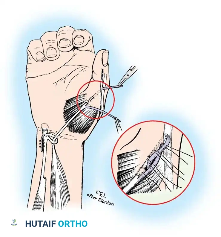 Fig. 68-5 Riordan transfer to restore opposition (see text).