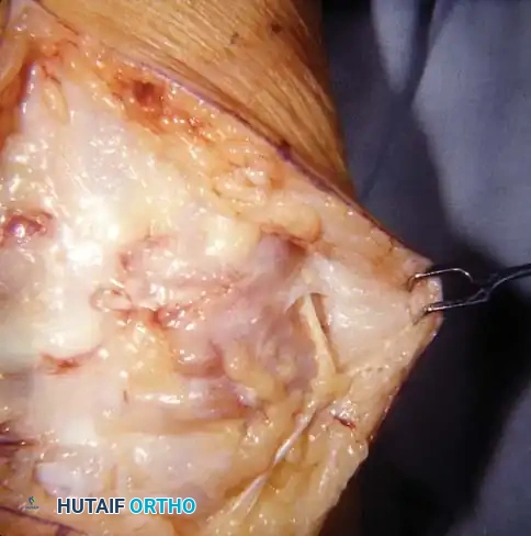 Rheumatoid Wrist Deformities: Surgical Management