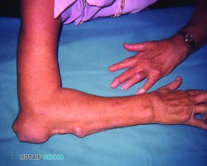 RHEUMATOID NODULES Surgical Diagram