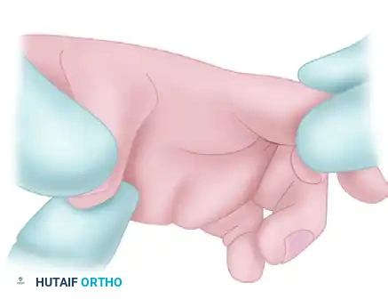 Ring Sublimis Opponensplasty with Ulnar Collateral Ligament Reconstruction