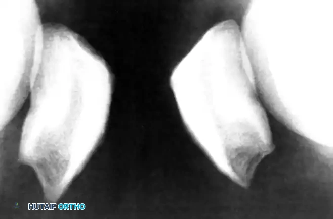 RUPTURE OF GASTROCNEMIUS MUSCLE Surgical Diagram