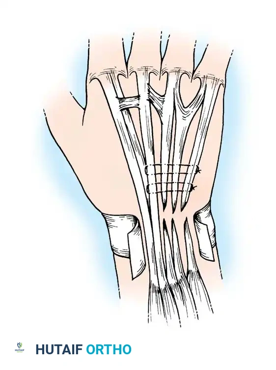 Operative Management of Tendon Ruptures and Synovitis in the Rheumatoid Hand