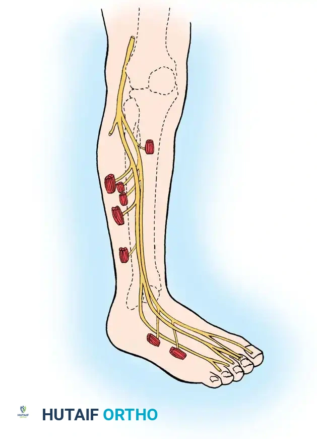 Skin incision for approach to proximal portion of sciatic nerve
