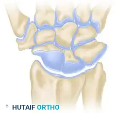 Mastering Limited Intercarpal Fusions: Scaphocapitate, Scaphocapitolunate, and Lunotriquetral Arthrodesis