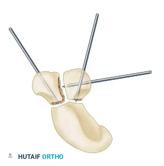 Cancellous Bone Packed and Pins Driven
