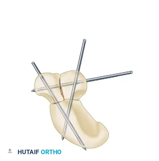 Pins Preset Retrograde