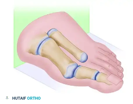 تأثير العوامل الميكانيكية على القدم