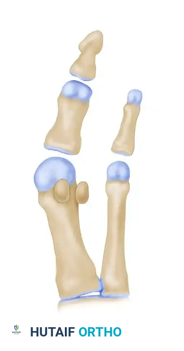 عملية سكارف لعلاج انحراف إصبع القدم الأكبر الدليل الطبي الشامل