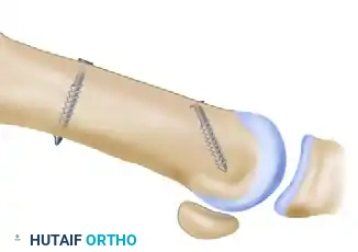 تطور التشوه مع مرور الوقت