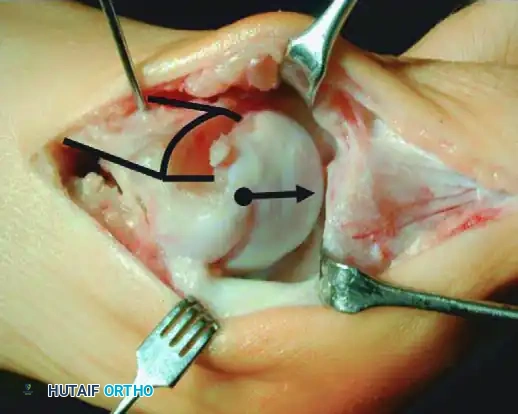 التصوير الشعاعي للقدم