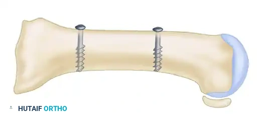 إزاحة العظم لتصحيح الزاوية