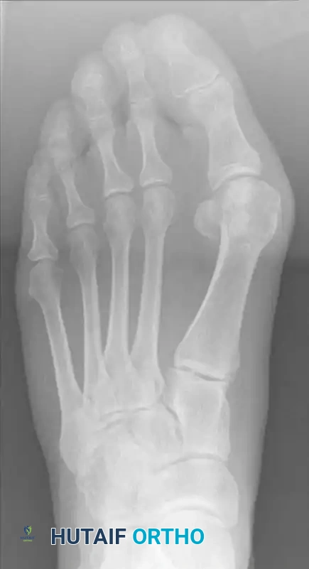 الخطوات الأولى للشق الجراحي