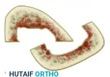 التثبيت النهائي باستخدام المسامير