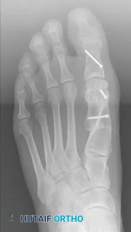 تنفيذ القطع العظمي على شكل حرف زي