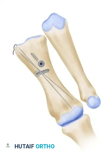 النتيجة النهائية بعد التئام العظام