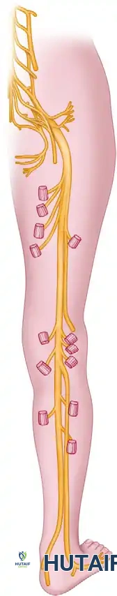 Sciatic Nerve Injuries: Surgical Anatomy, Approaches, and Management