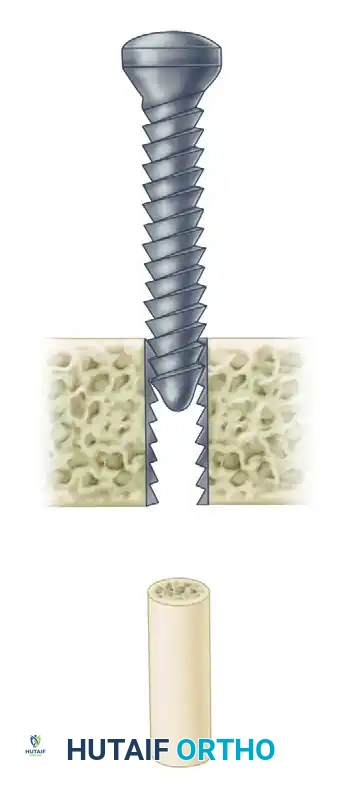 Masterclass in Orthopaedic Screw Fixation: Biomechanics, Implant Design, and Surgical Techniques