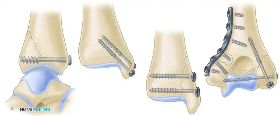 Masterclass in Lag Screw Fixation: Principles, Biomechanics, and Surgical Technique