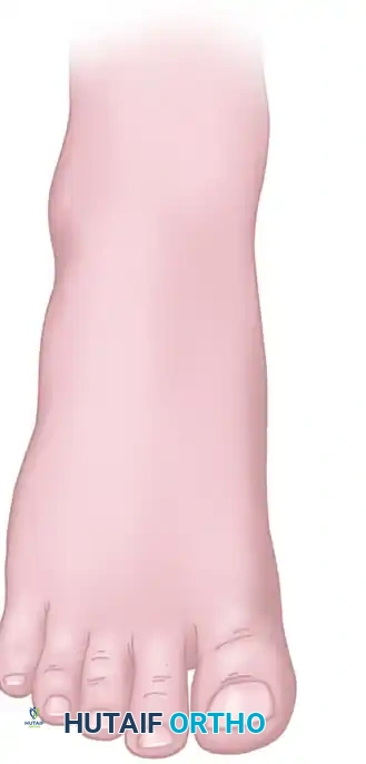 SECOND AND THIRD TOE TRANSPLANTATION Surgical Diagram