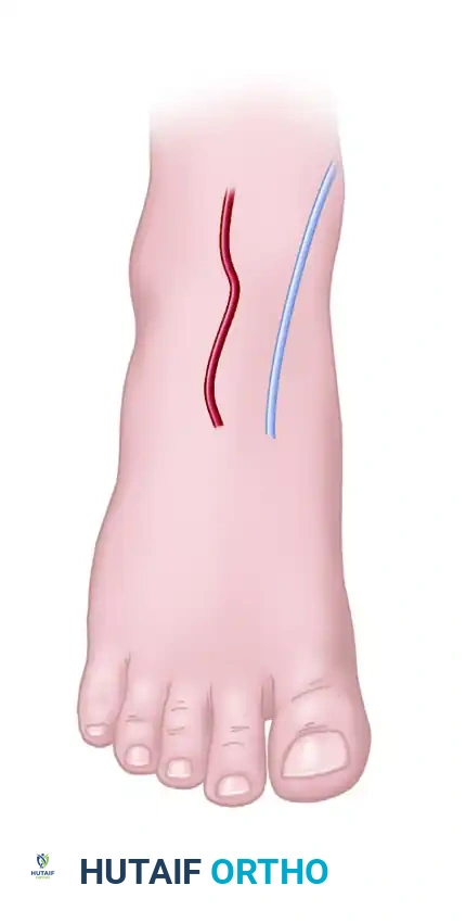 SECOND AND THIRD TOE TRANSPLANTATION Surgical Diagram
