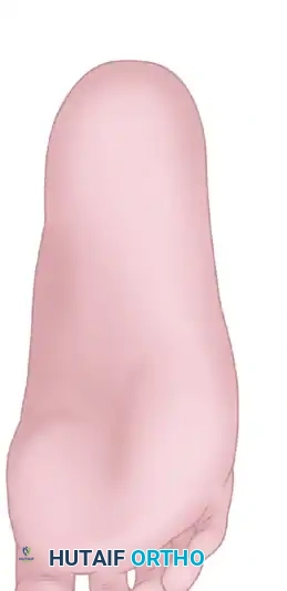 SECOND AND THIRD TOE TRANSPLANTATION Surgical Diagram