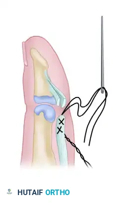 Suture Passing Through Profundus
