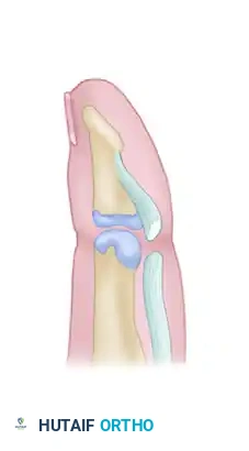 Secondary Repair and Reconstruction of Flexor Tendons: A Comprehensive Surgical Guide