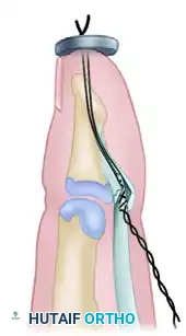 Pull-Out Button Suture