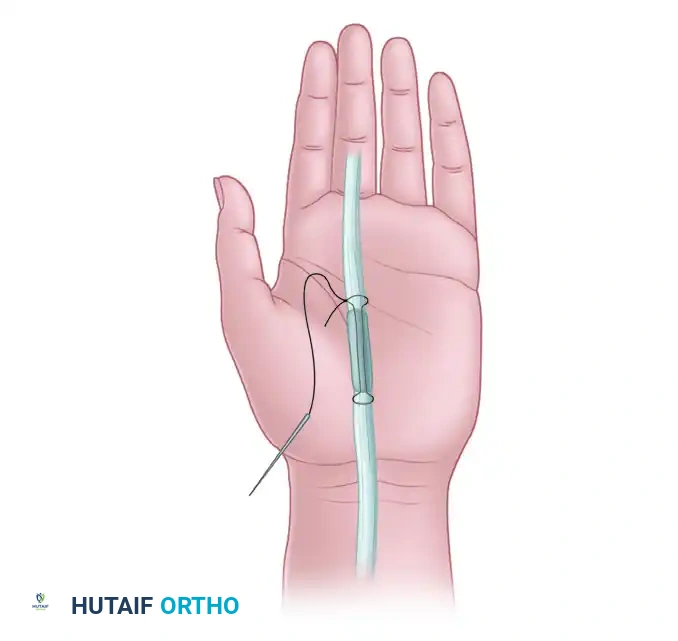 Short Segmental Graft in Palm