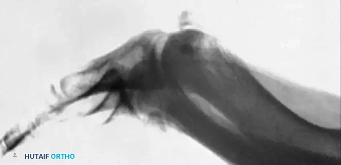 SESAMOID INJURIES OF THE HALLUX Surgical Diagram