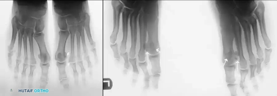 SESAMOID INJURIES OF THE HALLUX Surgical Diagram