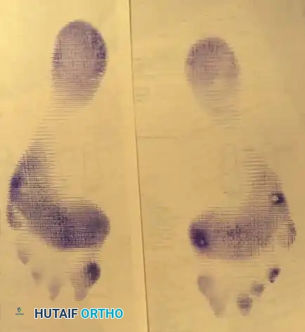 Fig. 78-99 A and B, Plantar ﬂ exed ﬁ rst ray with callus beneath tibial sesamoid. C, On Harris pressure mat, note increased pressure beneath tibial sesamoid. D, Tibial sesamoid has been removed, and articular surface and corresponding facet of metatarsal head show degenerative changes.