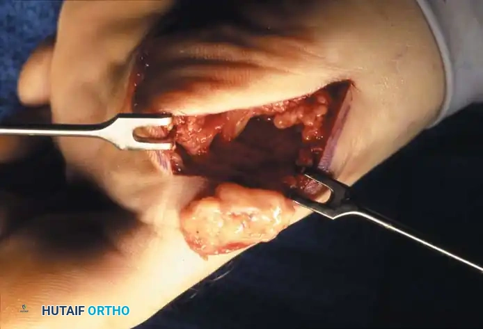 Fig. 78-99 A and B, Plantar ﬂ exed ﬁ rst ray with callus beneath tibial sesamoid. C, On Harris pressure mat, note increased pressure beneath tibial sesamoid. D, Tibial sesamoid has been removed, and articular surface and corresponding facet of metatarsal head show degenerative changes.